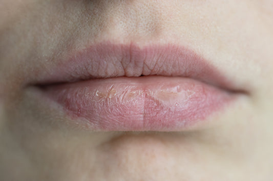 Close-up of chapped, peeling lips — showing the effects of severe dryness and the need for nourishing lip balm.